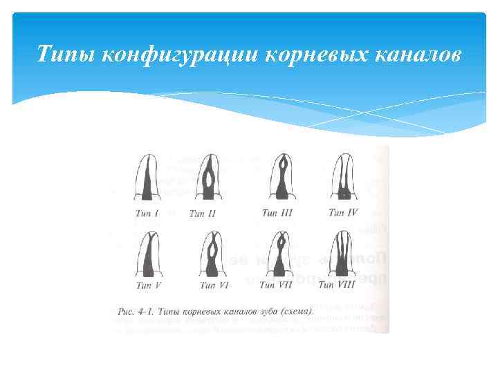 Типы конфигурации корневых каналов 