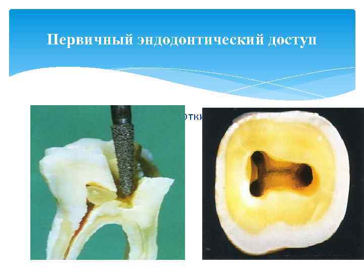 Первичный эндодонтический доступ должен быть самым коротким и и самым прямым! 