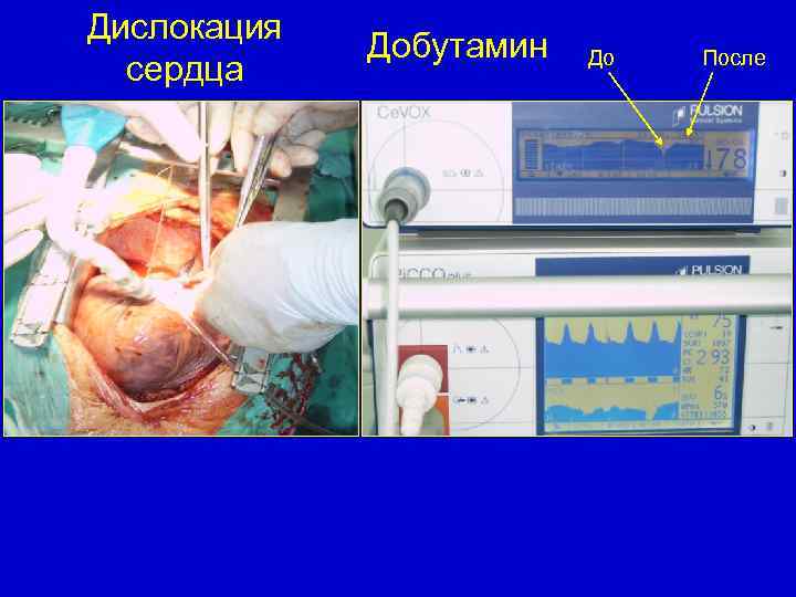 Дислокация сердца Добутамин До После 