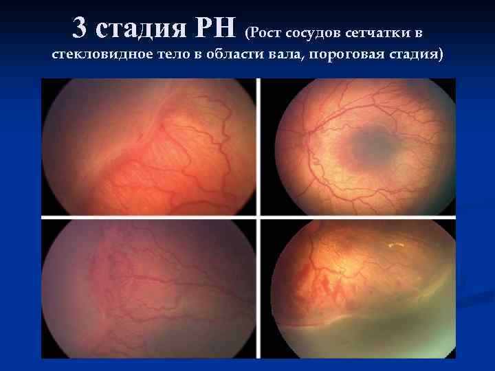 3 стадия РН (Рост сосудов сетчатки в стекловидное тело в области вала, пороговая стадия)