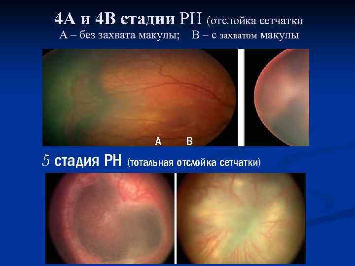 4 А и 4 В стадии РН (отслойка сетчатки А – без захвата макулы;