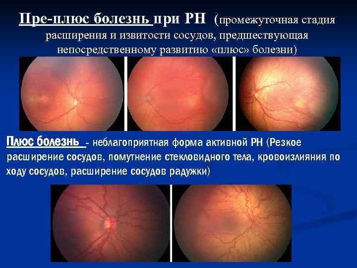 Пре-плюс болезнь при РН (промежуточная стадия расширения и извитости сосудов, предшествующая непосредственному развитию «плюс»