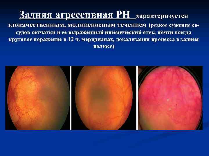 Задняя агрессивная РН характеризуется злокачественным, молниеносным течением (резкое сужение сосудов сетчатки и ее выраженный