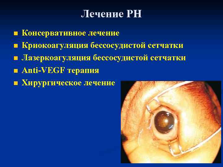 Лечение РН n n n Консервативное лечение Криокоагуляция бессосудистой сетчатки Лазеркоагуляция бессосудистой сетчатки Аnti-VEGF