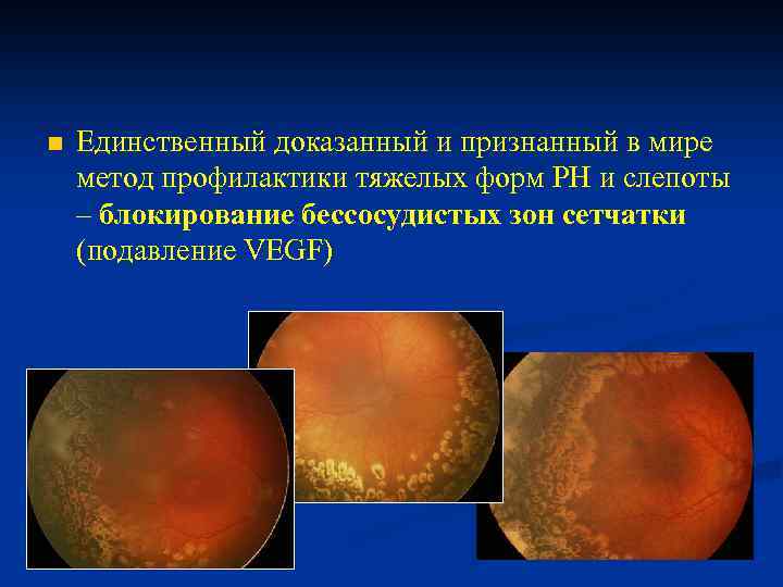 n Единственный доказанный и признанный в мире метод профилактики тяжелых форм РН и слепоты