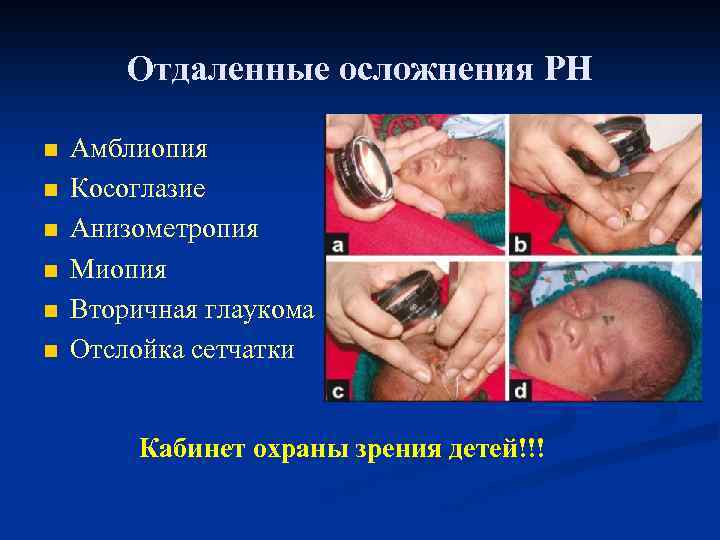 Отдаленные осложнения РН n n n Амблиопия Косоглазие Анизометропия Миопия Вторичная глаукома Отслойка сетчатки