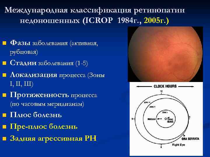 Международная классификация ретинопатии недоношенных (ICROP 1984 г. , 2005 г. ) n Фазы заболевания