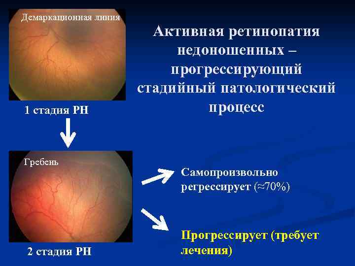 Демаркационная линия 1 стадия РН Гребень 2 стадия РН Активная ретинопатия недоношенных – прогрессирующий