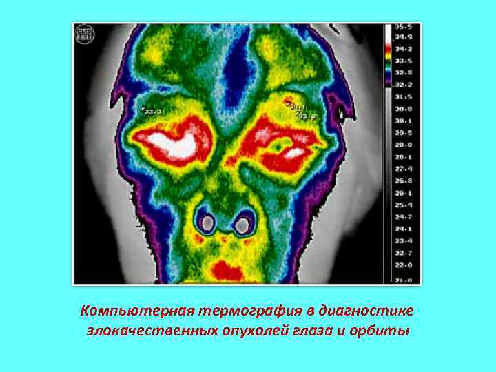  Компьютерная термография в диагностике злокачественных опухолей глаза и орбиты 