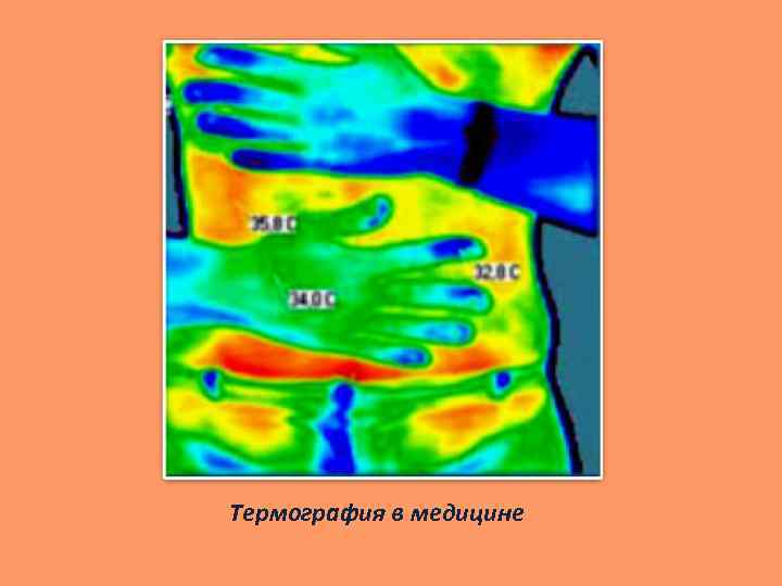Термография в медицине 