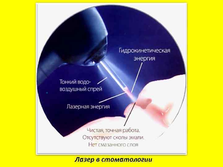 Лазер в стоматологии 
