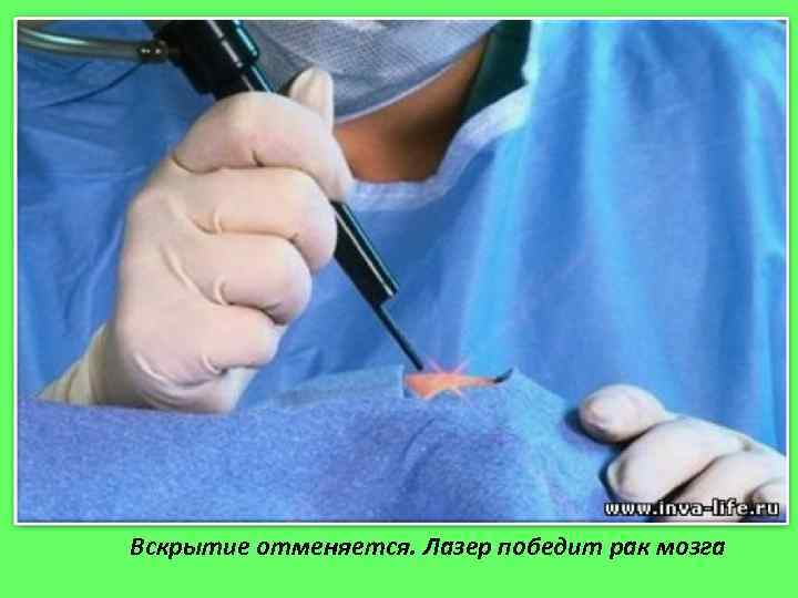 Вскрытие отменяется. Лазер победит рак мозга 