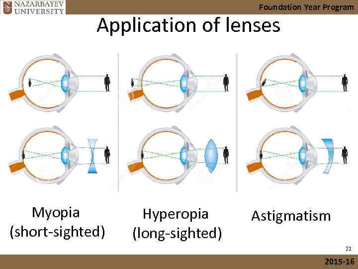 Foundation Year Program Application of lenses Myopia (short-sighted) Hyperopia (long-sighted) Astigmatism 21 2015 -16