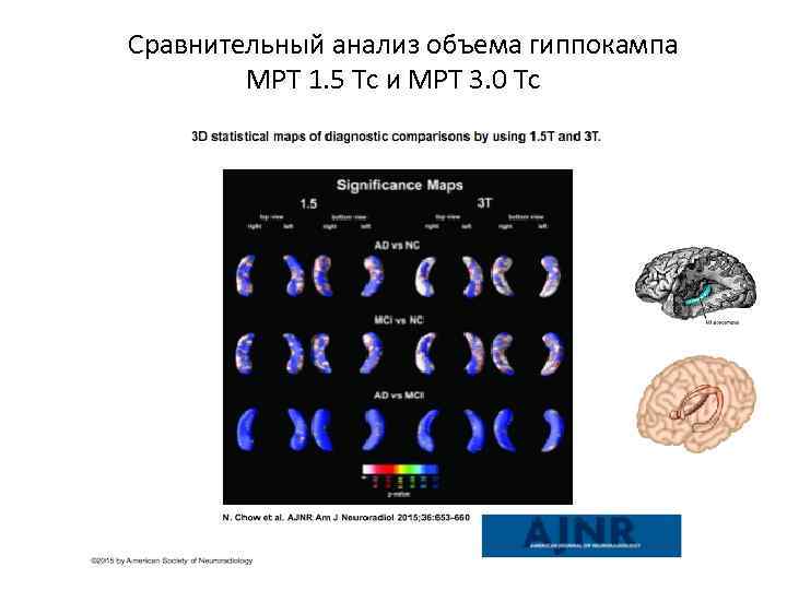  Сравнительный анализ объема гиппокампа МРТ 1. 5 Тс и МРТ 3. 0 Тс
