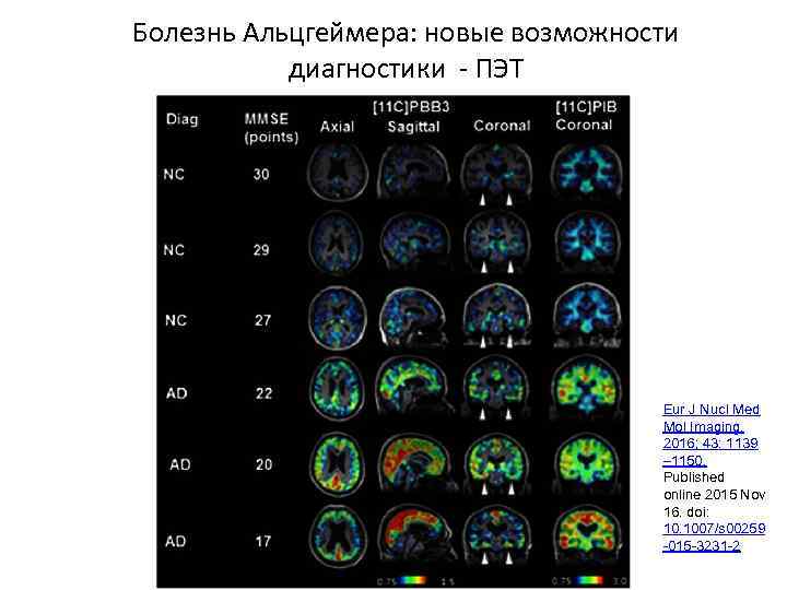 Болезнь Альцгеймера: новые возможности диагностики - ПЭТ Eur J Nucl Med Mol Imaging. 2016;