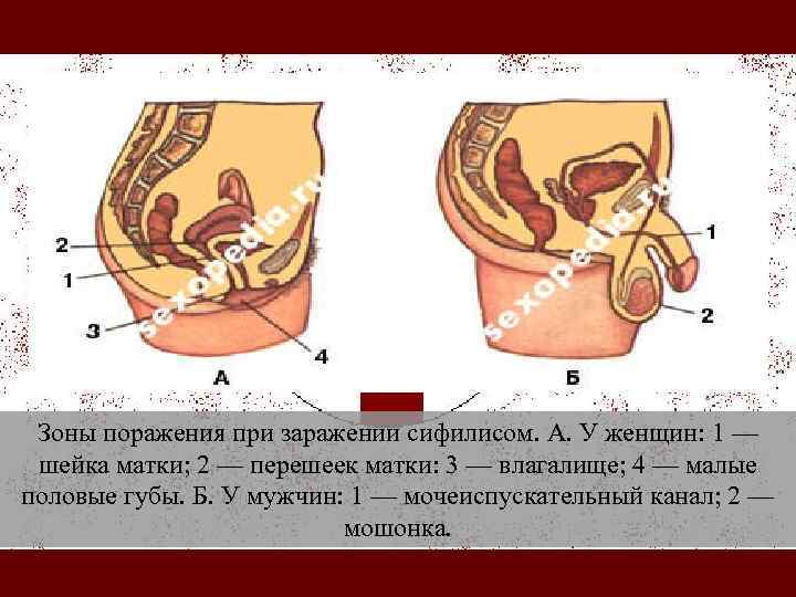 Зоны поражения при заражении сифилисом. А. У женщин: 1 — шейка матки; 2 —