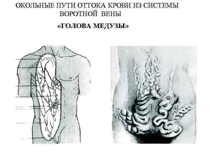 ОКОЛЬНЫЕ ПУТИ ОТТОКА КРОВИ ИЗ СИСТЕМЫ ВОРОТНОЙ ВЕНЫ «ГОЛОВА МЕДУЗЫ» 