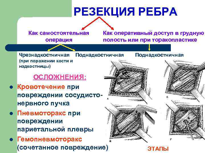 РЕЗЕКЦИЯ РЕБРА Как самостоятельная операция Чрезнадкостничная Как оперативный доступ в грудную полость или при