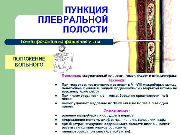 Пункция плевральной полости. Показания к пункции плевральной полости при гидротораксе. Пункцию плевральной полости при пневмотораксе проводят. Пункция при пневмотораксе и гидротораксе. Пункция грудной клетки при пневмотораксе.