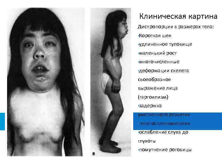 Клиническая картина Диспропорции в размерах тела: • Короткая шея • удлиненное • маленький туловище
