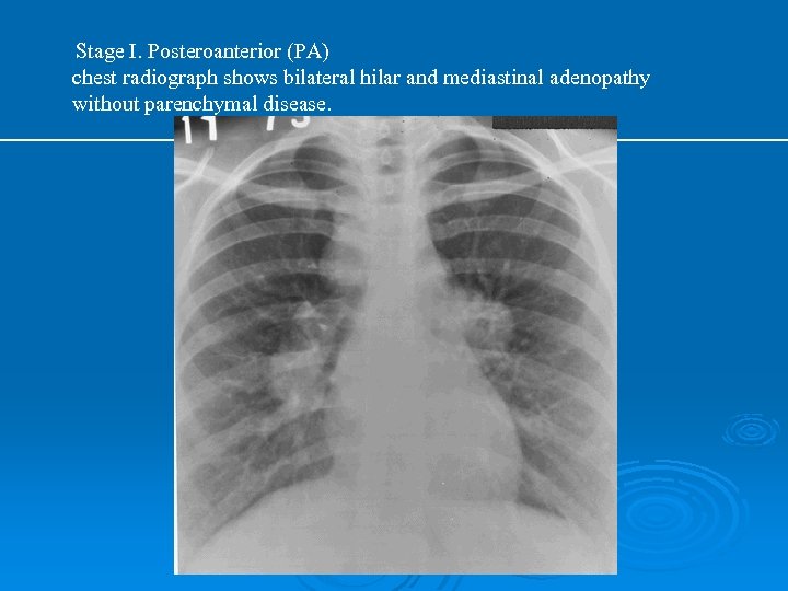 Stage I. Posteroanterior (PA) chest radiograph shows bilateral hilar and mediastinal adenopathy without parenchymal