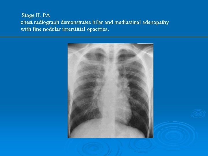 Stage II. PA chest radiograph demonstrates hilar and mediastinal adenopathy with fine nodular interstitial