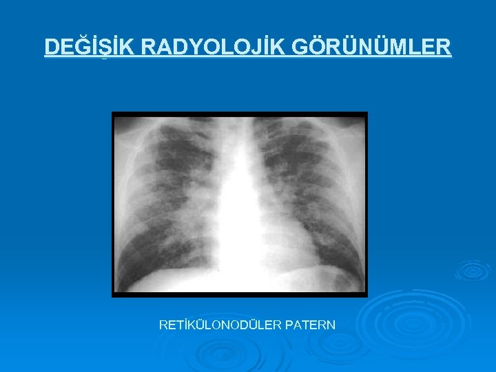 DEĞİŞİK RADYOLOJİK GÖRÜNÜMLER RETİKÜLONODÜLER PATERN 