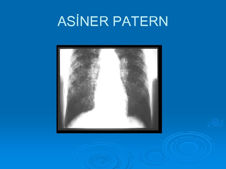 ASİNER PATERN 