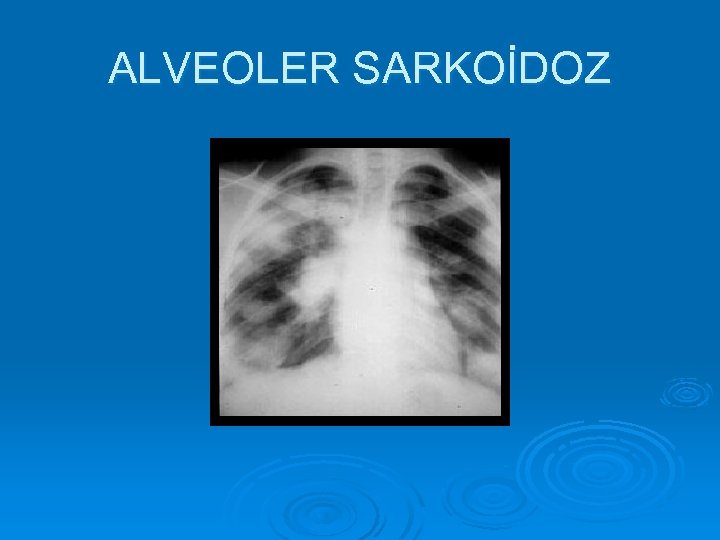 ALVEOLER SARKOİDOZ 