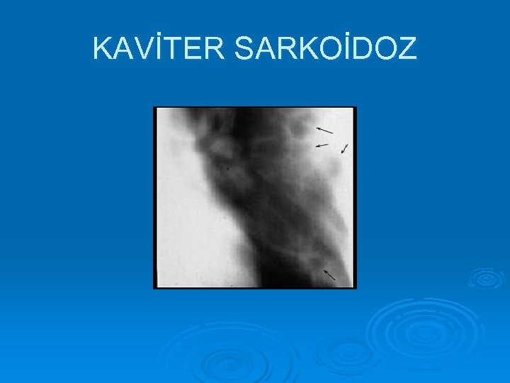 KAVİTER SARKOİDOZ 