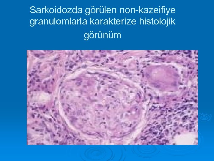 Sarkoidozda görülen non-kazeifiye granulomlarla karakterize histolojik görünüm 