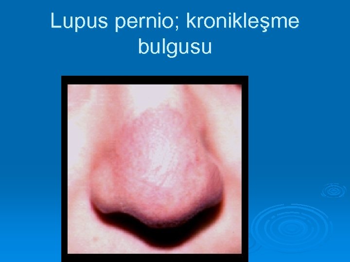 Lupus pernio; kronikleşme bulgusu 