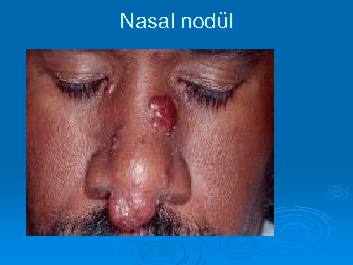 Nasal nodül 