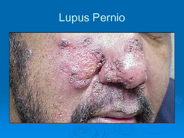 Lupus Pernio 