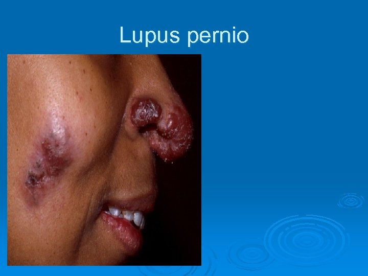 Lupus pernio 