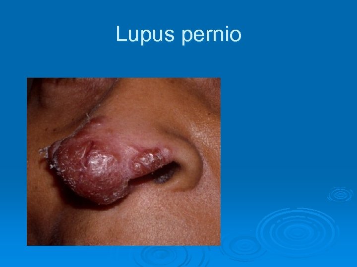 Lupus pernio 
