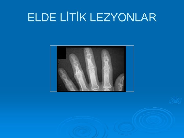 ELDE LİTİK LEZYONLAR 