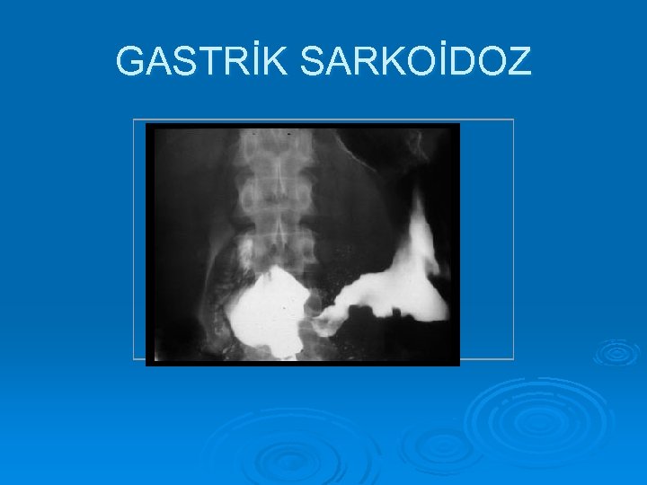 GASTRİK SARKOİDOZ 