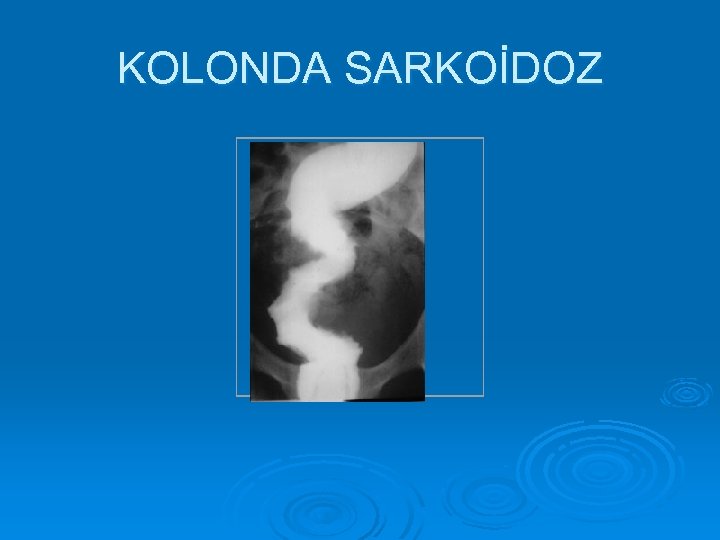 KOLONDA SARKOİDOZ 