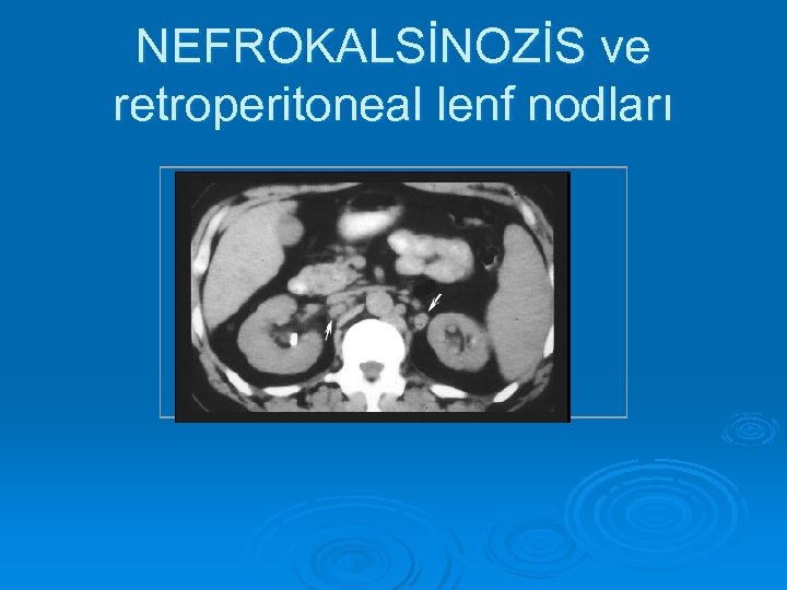 NEFROKALSİNOZİS ve retroperitoneal lenf nodları 