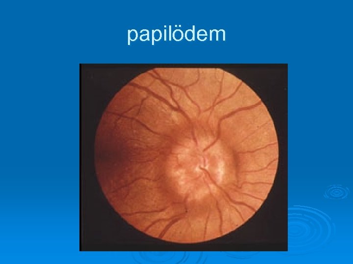 papilödem 