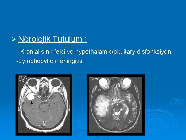 Ø Nörolojik Tutulum : -Kranial sinir felci ve hypothalamic/pituitary disfonksiyon. -Lymphocytic meningitis 