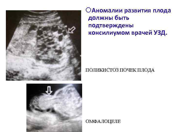  Аномалии развития плода должны быть подтверждены консилиумом врачей УЗД. ПОЛИКИСТОЗ ПОЧЕК ПЛОДА ОМФАЛОЦЕЛЕ