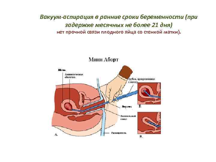 Вакуум-аспирация в ранние сроки беременности (при задержке месячных не более 21 дня) нет прочной