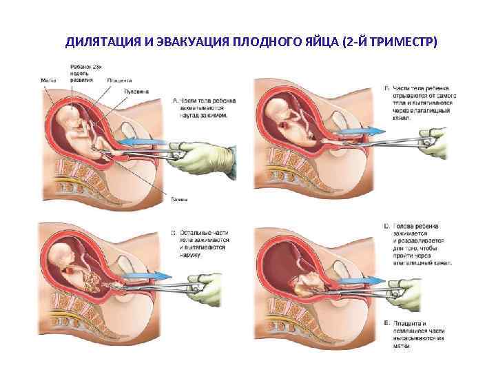 ДИЛЯТАЦИЯ И ЭВАКУАЦИЯ ПЛОДНОГО ЯЙЦА (2 -Й ТРИМЕСТР) 
