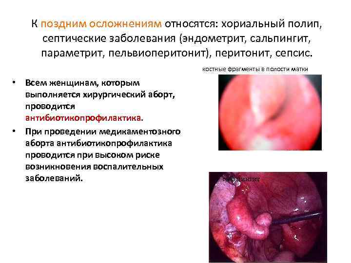 К поздним осложнениям относятся: хориальный полип, септические заболевания (эндометрит, сальпингит, параметрит, пельвиоперитонит), перитонит, сепсис.