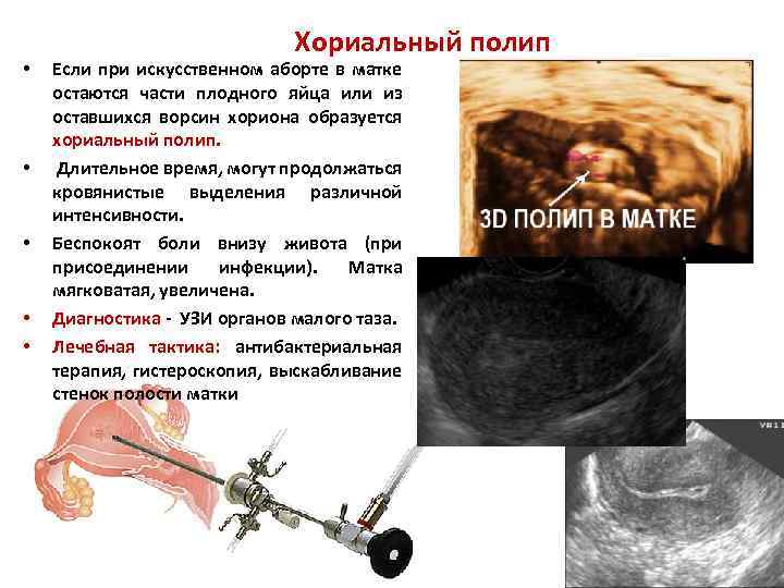  • • • Хориальный полип Если при искусственном аборте в матке остаются части