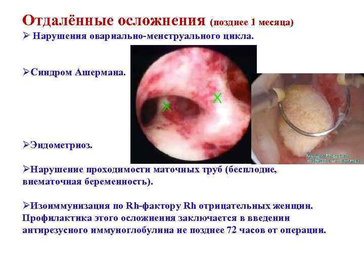 Отдалённые осложнения (позднее 1 месяца) Ø Нарушения овариально-менструального цикла. ØСиндром Ашермана. ØЭндометриоз. ØНарушение проходимости