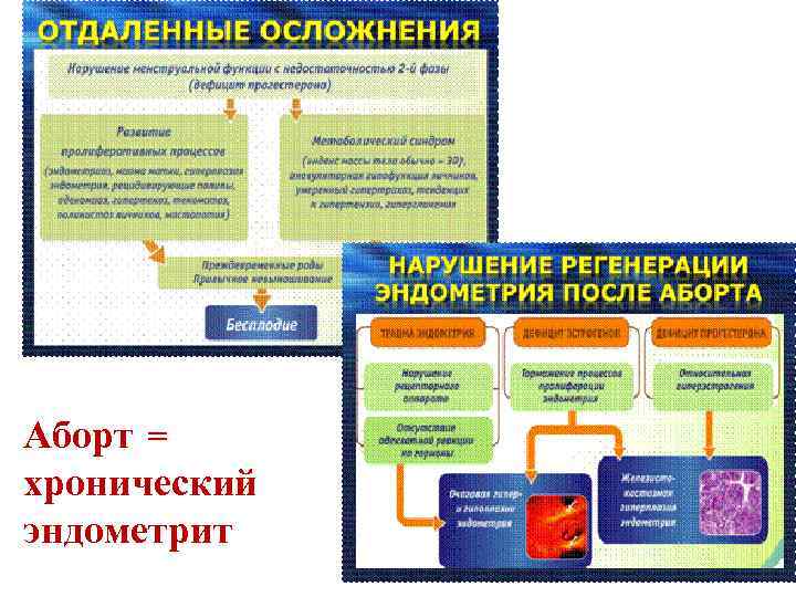 Аборт = хронический эндометрит 