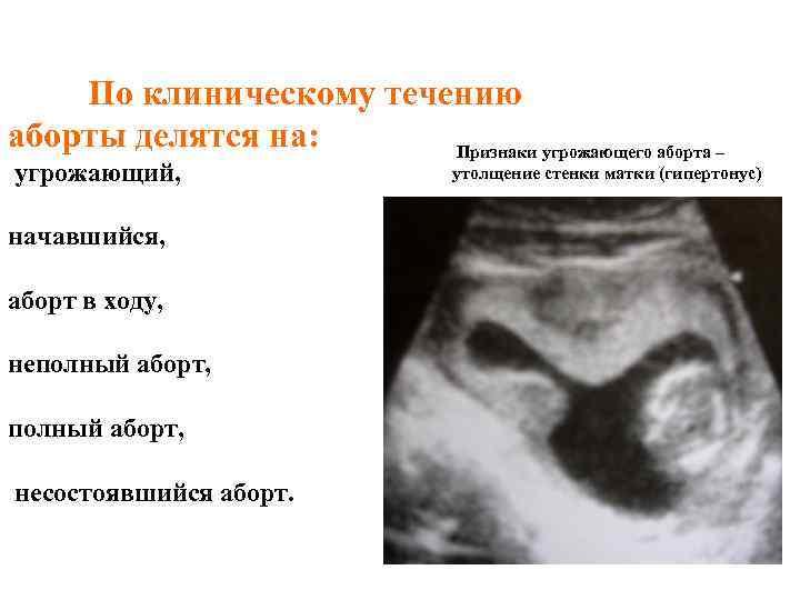 По клиническому течению аборты делятся на: Признаки угрожающего аборта – угрожающий, начавшийся, аборт в